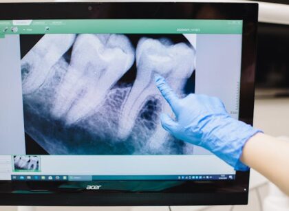 Co to jest tomografia zęba i na czym polega?