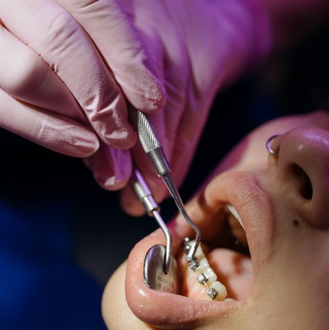 Czy Invisalign naprawdę prostuje zęby?